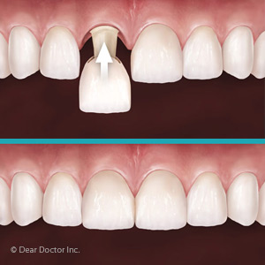 Customized Temporary Crowns Help Ensure a Satisfying Permanent Smile