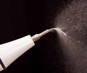 Ultrasonic Plaque Removal an Effective Alternative to Manual Scaling