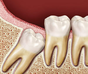 Wisdom Teeth and What to Do About Them