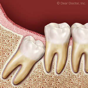 Wisdom Teeth and What to Do About Them