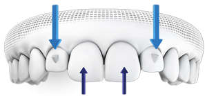 Invisalign Smart Force innovations