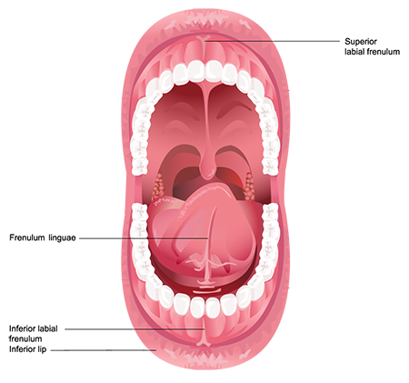 Laser_Frenectomy-450px