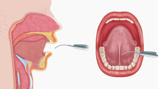 laserFrenectomy-650px