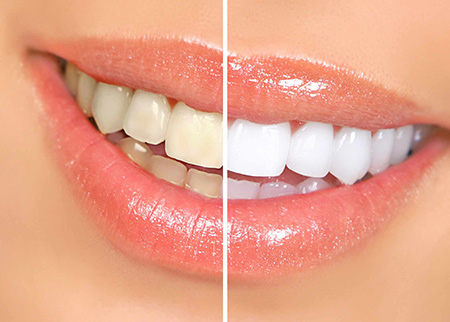 teethwhitening-450px