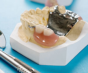 A RPD Could Be Your Answer to Replacing Missing Teeth