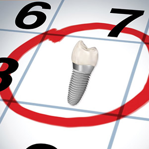 How Long Is the Implant Process?