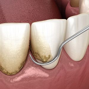 Periodontal Disease – Protect your Gums