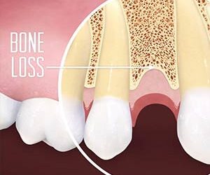 Overcoming Bone Loss Preventing You From Getting an Implant