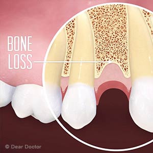 Overcoming Bone Loss Preventing You From Getting an Implant