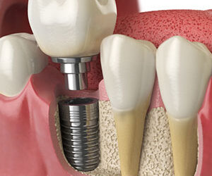 4 Reasons Dental Implants Are a Wise Choice for Tooth Replacement