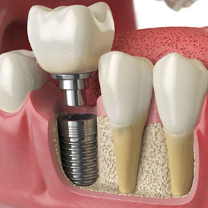 4 Reasons Dental Implants Are a Wise Choice for Tooth Replacement