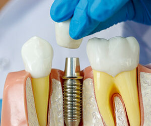 Dental Implants Could Help Preserve Bone After Tooth Loss