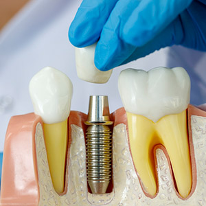 Dental Implants Could Help Preserve Bone After Tooth Loss