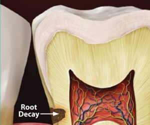 Stay Ahead of Decay-Spreading Root Cavities