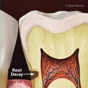 Stay Ahead of Decay-Spreading Root Cavities