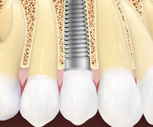 Here’s What You Can Expect With Dental Implant Surgery