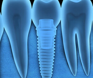 Could Your Metal Allergy Keep You From Obtaining Dental Implants?