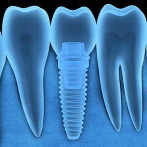 Could Your Metal Allergy Keep You From Obtaining Dental Implants?