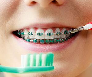 Practical Tips for Keeping Your Teeth Clean While Wearing Braces