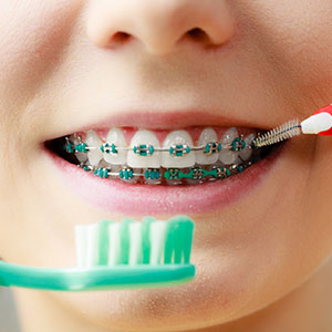 Practical Tips for Keeping Your Teeth Clean While Wearing Braces