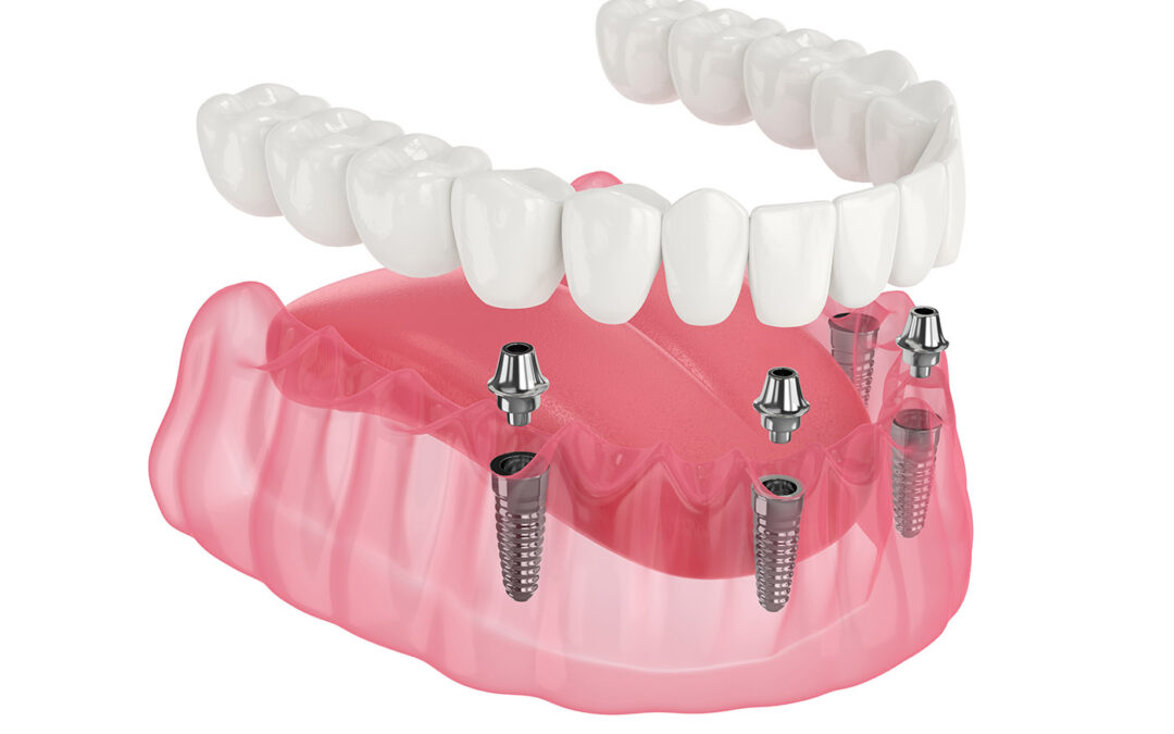 Traditional Implants vs All-on-4 Dental Implants