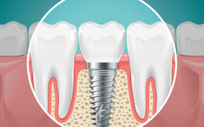 The Power of Same Day Dental Implants